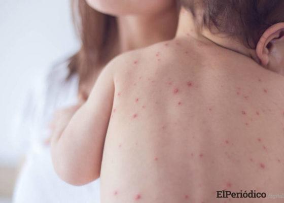 alarmante brote de sarampión en los países europeos