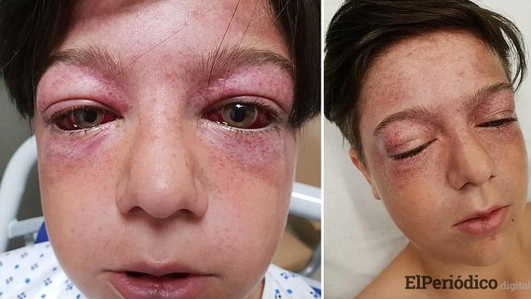 Un peligroso reto de Youtube causo fuertes heridas a un niño de 11 años en el Reino Unido niño