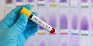 Hepatitis C: causas, tratamiento y el síntoma que muchas personas pasan por alto según los médicos