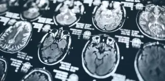 El párkinson y el TDAH se asocian con ciertos genes que afectan al volumen cerebral, según nuevos estudios