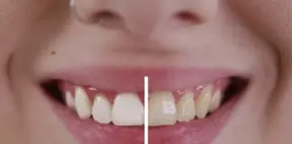 Adiós sarro dental: causas y efectos de la alimentación según una odontóloga
