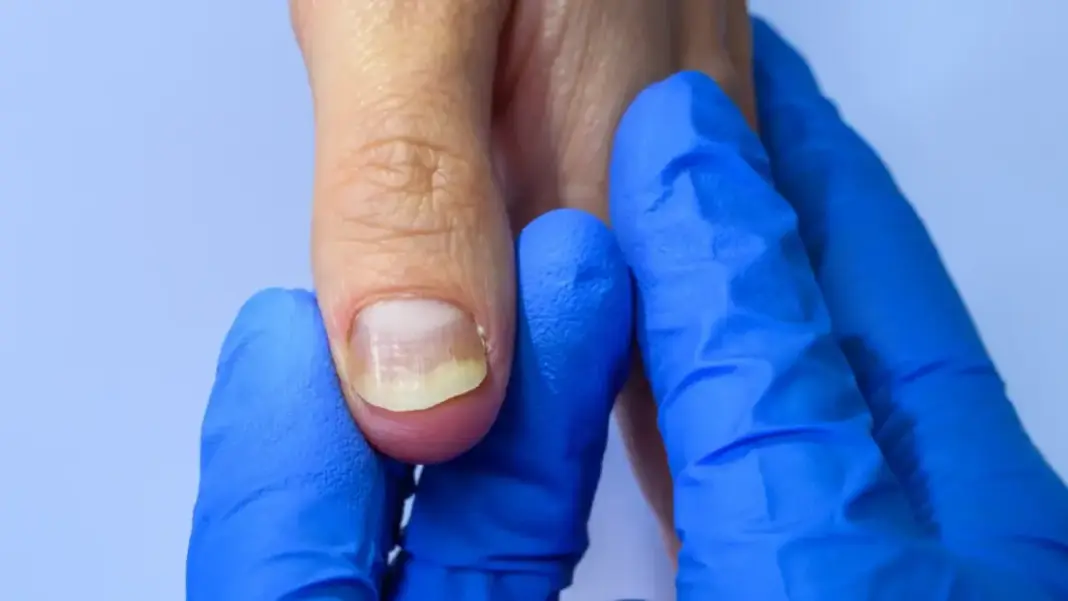 ¿Qué es la psoriasis ungueal? Signos ycausas de esta enfermedad de las uñas