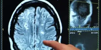 La costumbre diaria que reduce el riesgo de un derrame cerebral hasta en un tercio, según un estudio