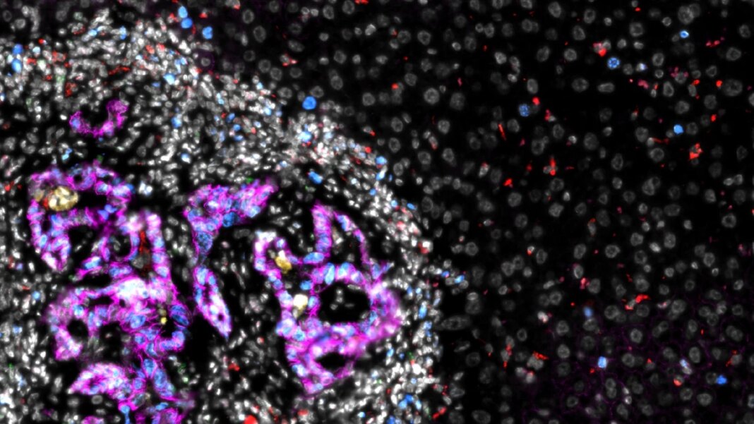 Investigadores españoles logran avances en el tratamiento contra el cáncer de hígado