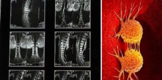 Denuncia que su madre murió después de que los médicos confundieran el cáncer con una lumbalgia