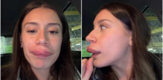 Las impactantes secuelas de la famosa tiktoker Sandra González tras un tratamiento con ácido hialurónico: "No es un filtro"