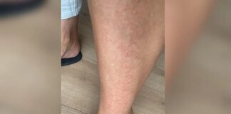 Vecinos de Rincón de la Victoria alertan de una plaga de orugas en su urbanización